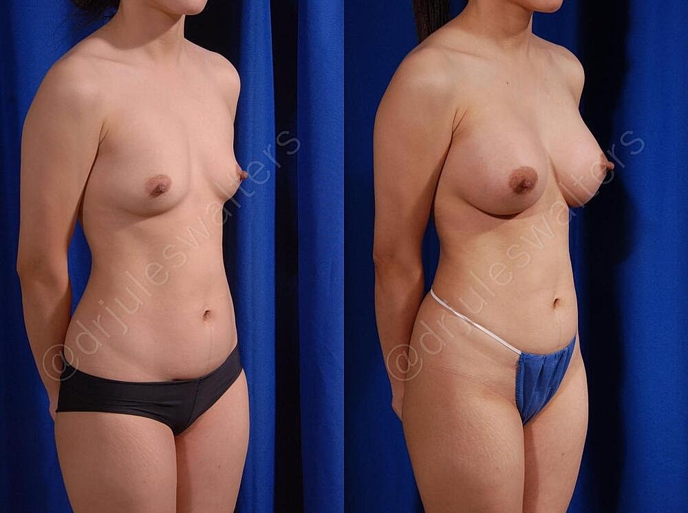 Breast Augmentation Before & After
