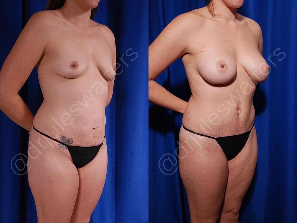 Breast Augmentation Before & After