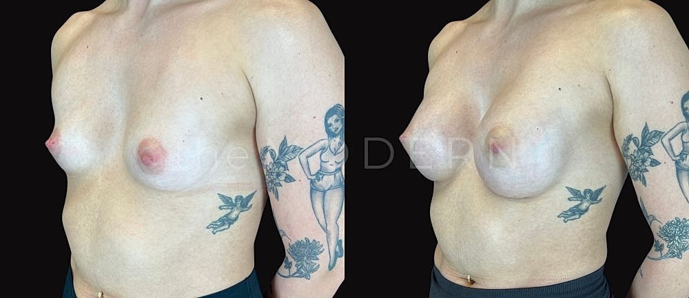 Comparison of chest appearance before and after.