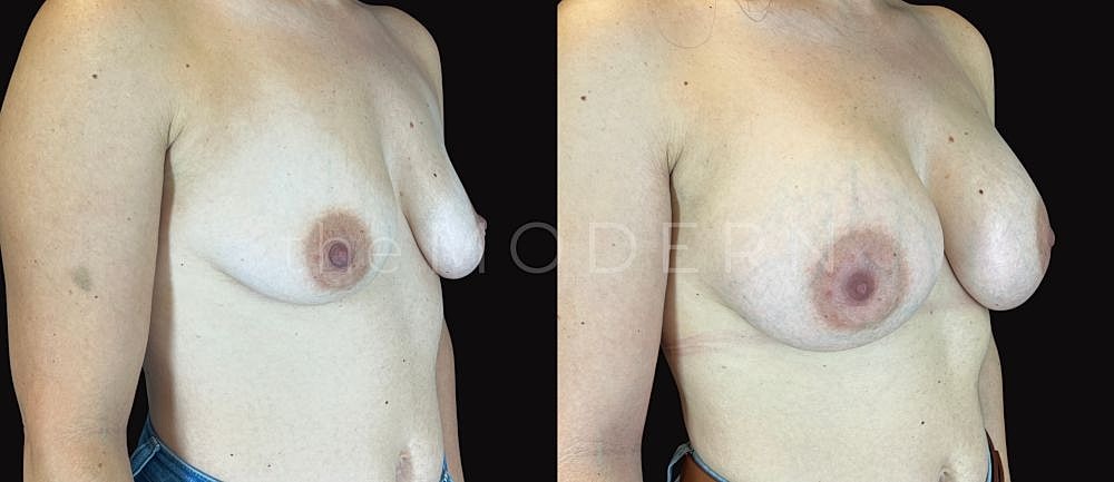 Breast augmentation before and after comparison.