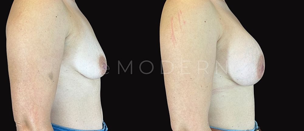 Side profile comparison of breast appearance.