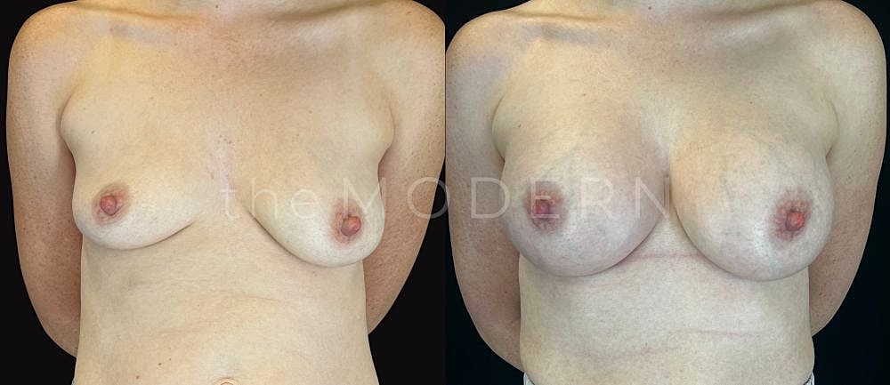 Before and after breast augmentation comparison.