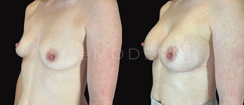 Before and after breast procedure comparison image