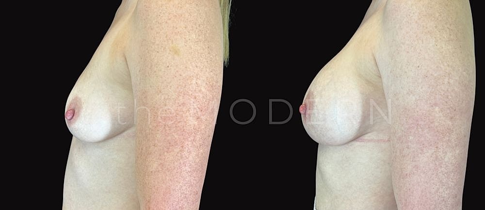 Side view of female torso contrast comparison.