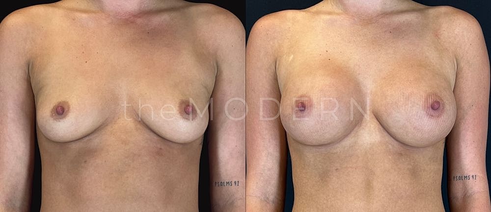 Before and after breast augmentation comparison.