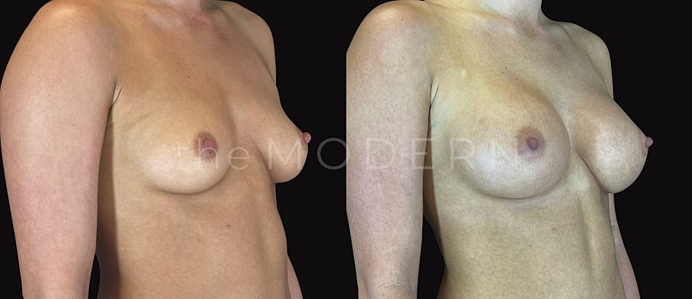 Breast augmentation before and after comparison.