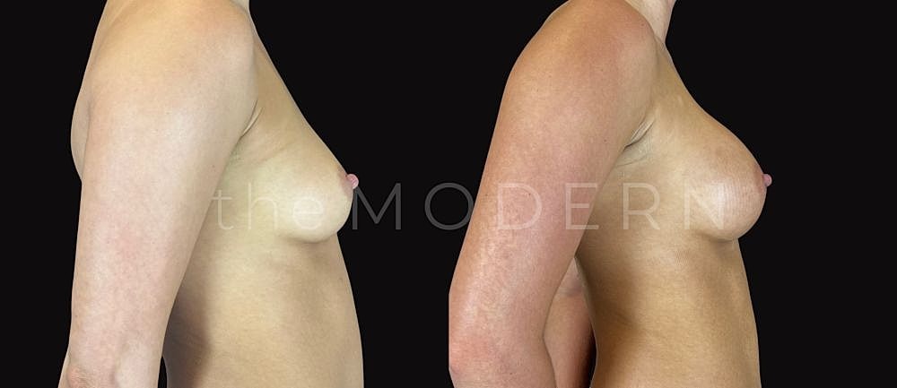 Before and after body contouring comparison image