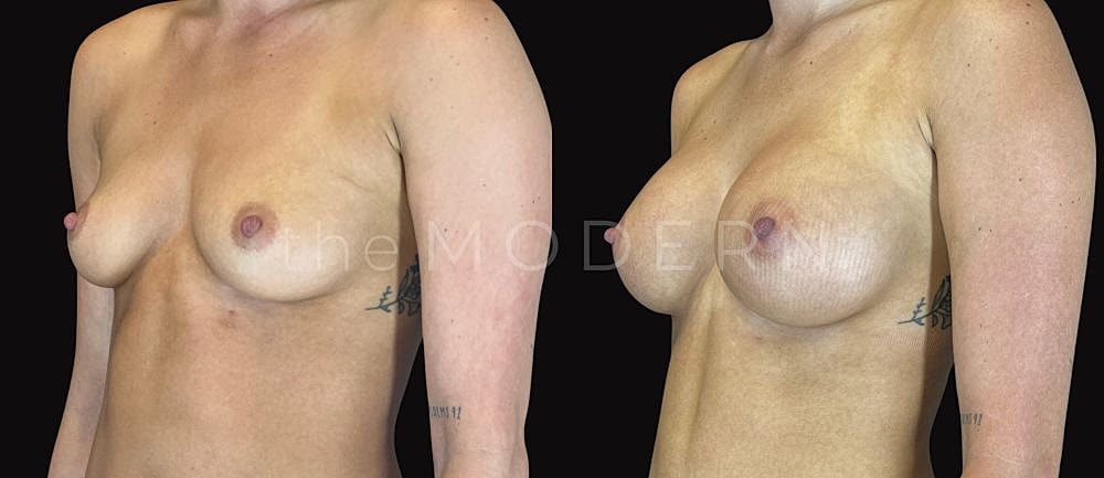 Before and after breast enhancement comparison.