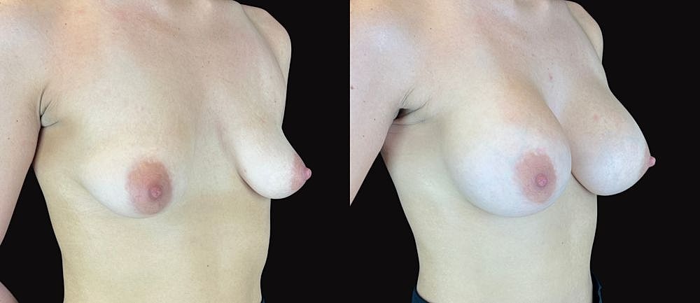 Before and after breast appearance comparison