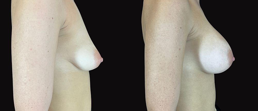 Comparison of breast shapes from different angles.