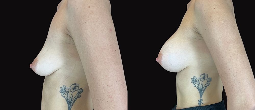 Breast form comparison with tattoo detail.