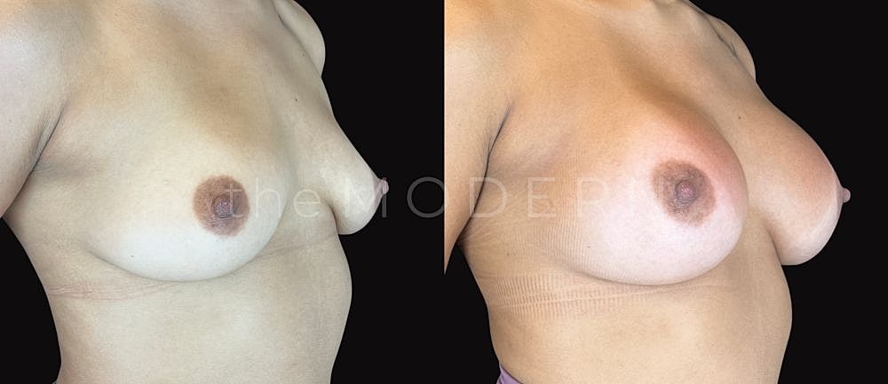Before and after breast augmentation comparison.