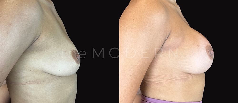 Before and after breast augmentation comparison.
