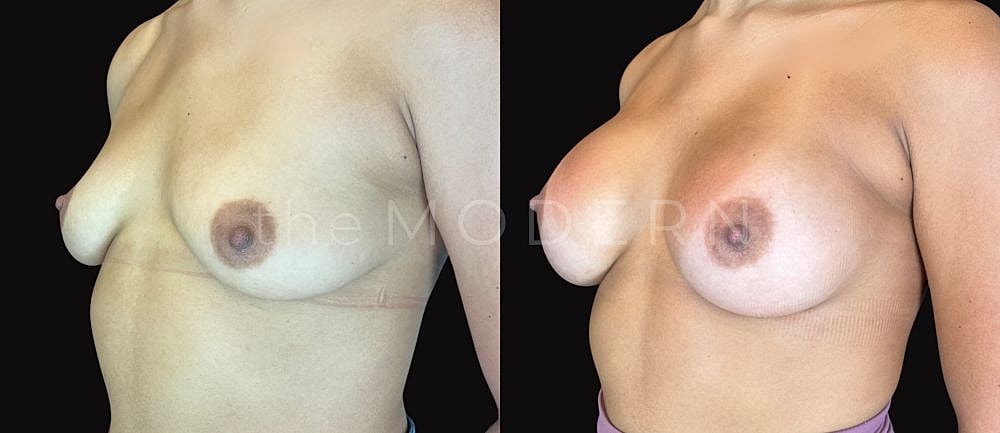 Before and after breast augmentation comparison image.