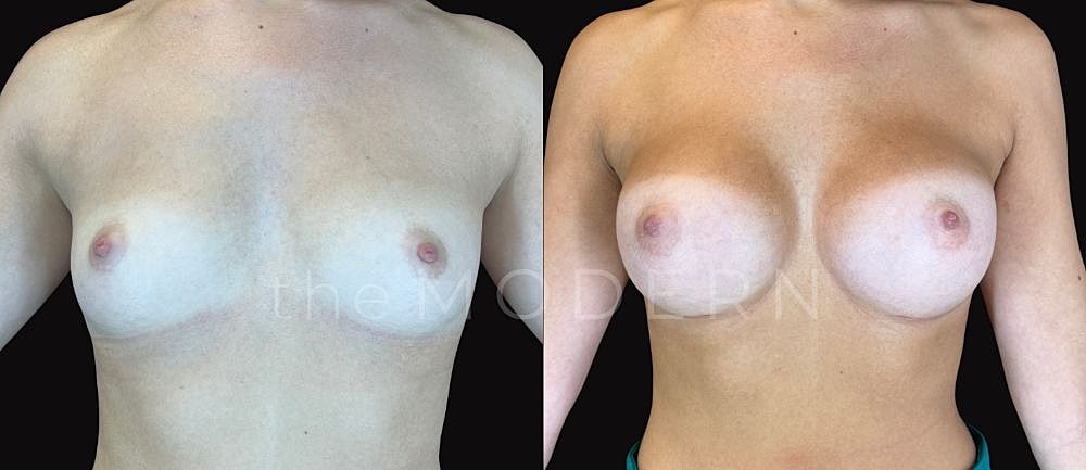Before and after breast augmentation comparison image.