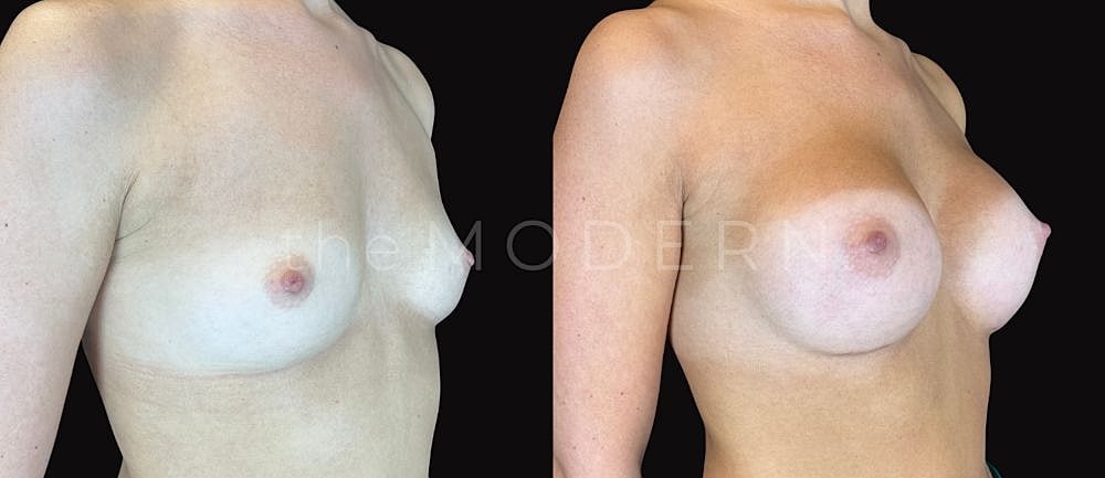 Before and after breast enhancement comparison image