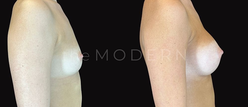 Before and after breast augmentation comparison side view