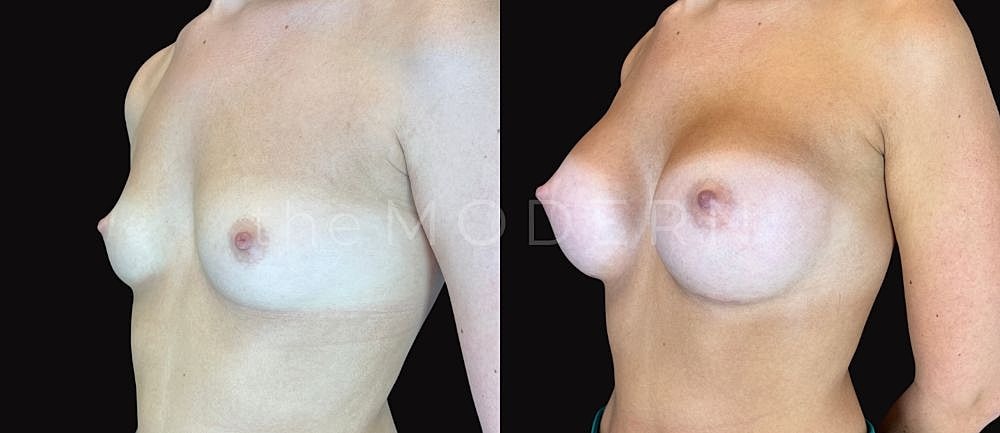 Before and after breast augmentation comparison image