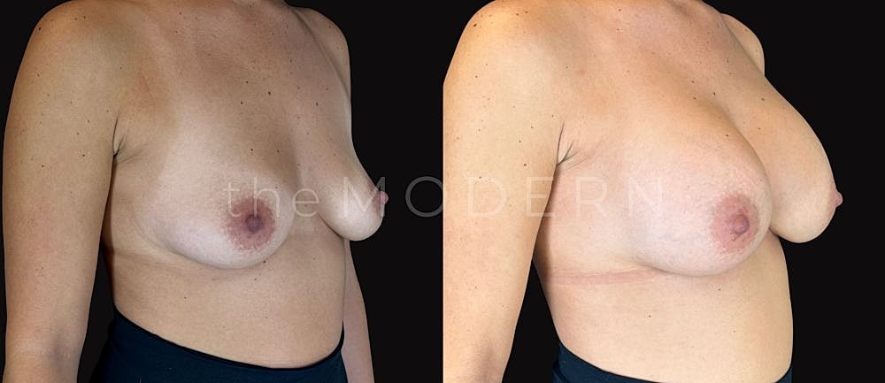 Before and after breast augmentation comparison image