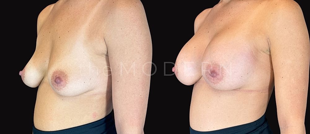 Post-operative breast enhancement before and after.