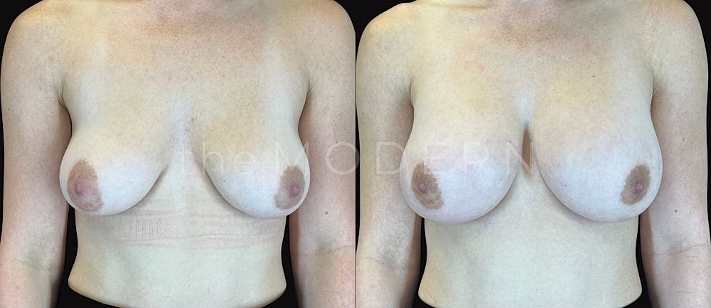 Breast augmentation before and after comparison.