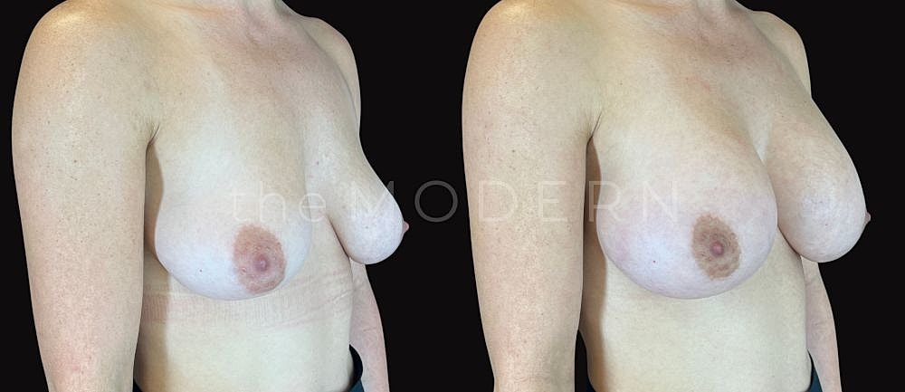 Before and after breast enhancement comparison.