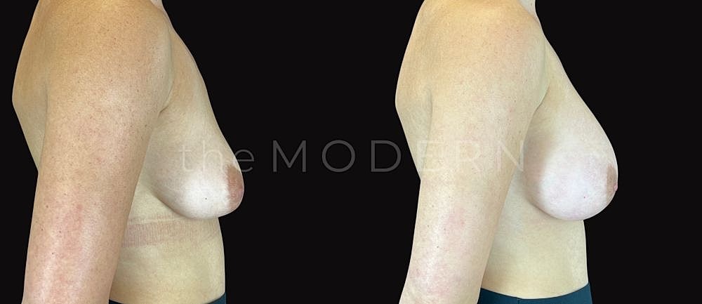 Before and after breast augmentation side profile.