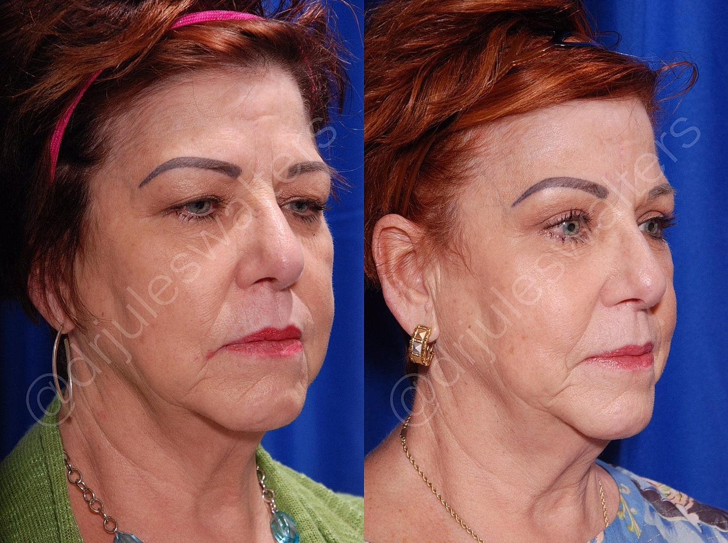 Blepharoplasty Before & After