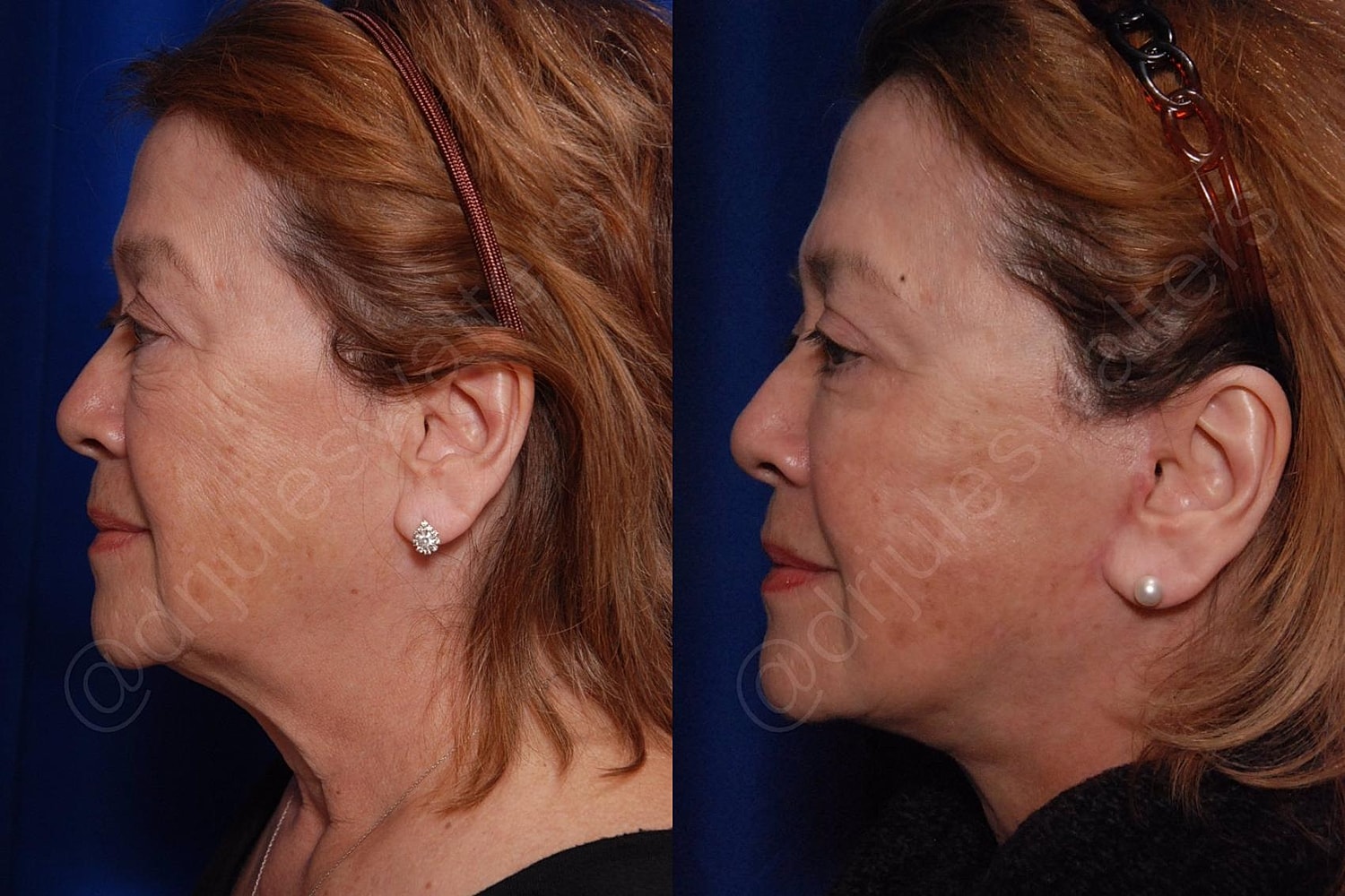 Blepharoplasty Before & After