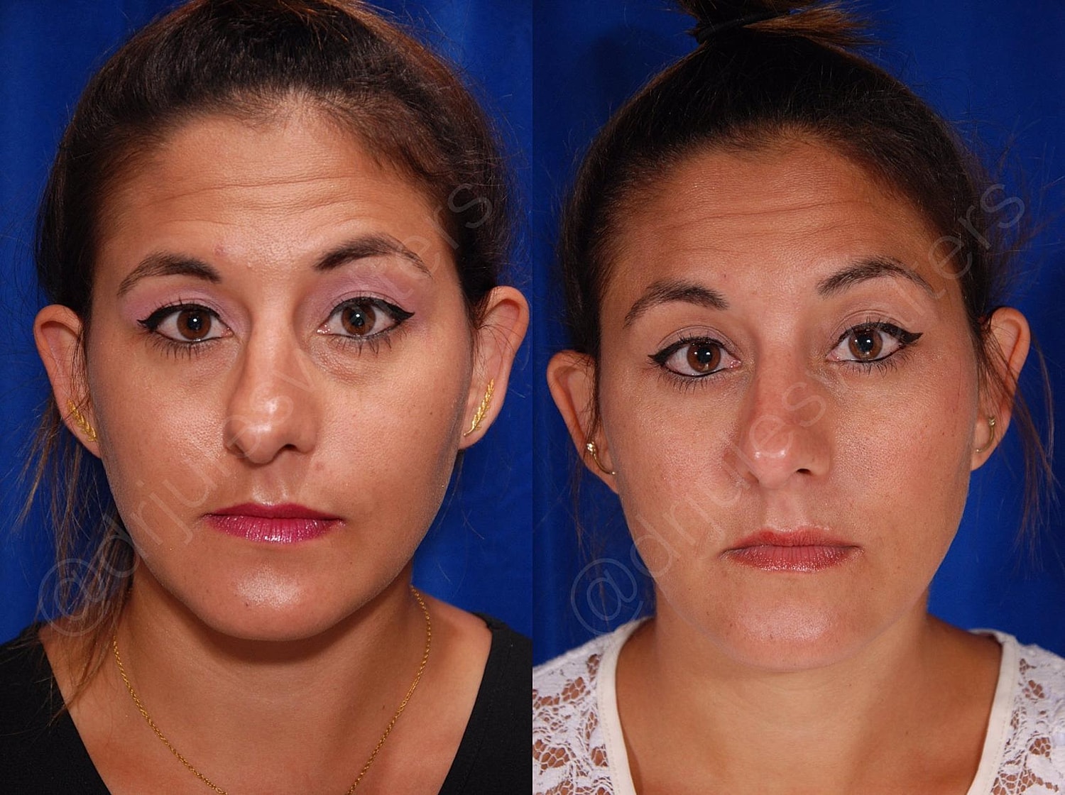 Blepharoplasty Before & After