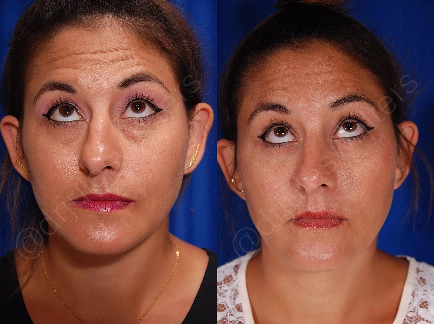 Blepharoplasty Before & After