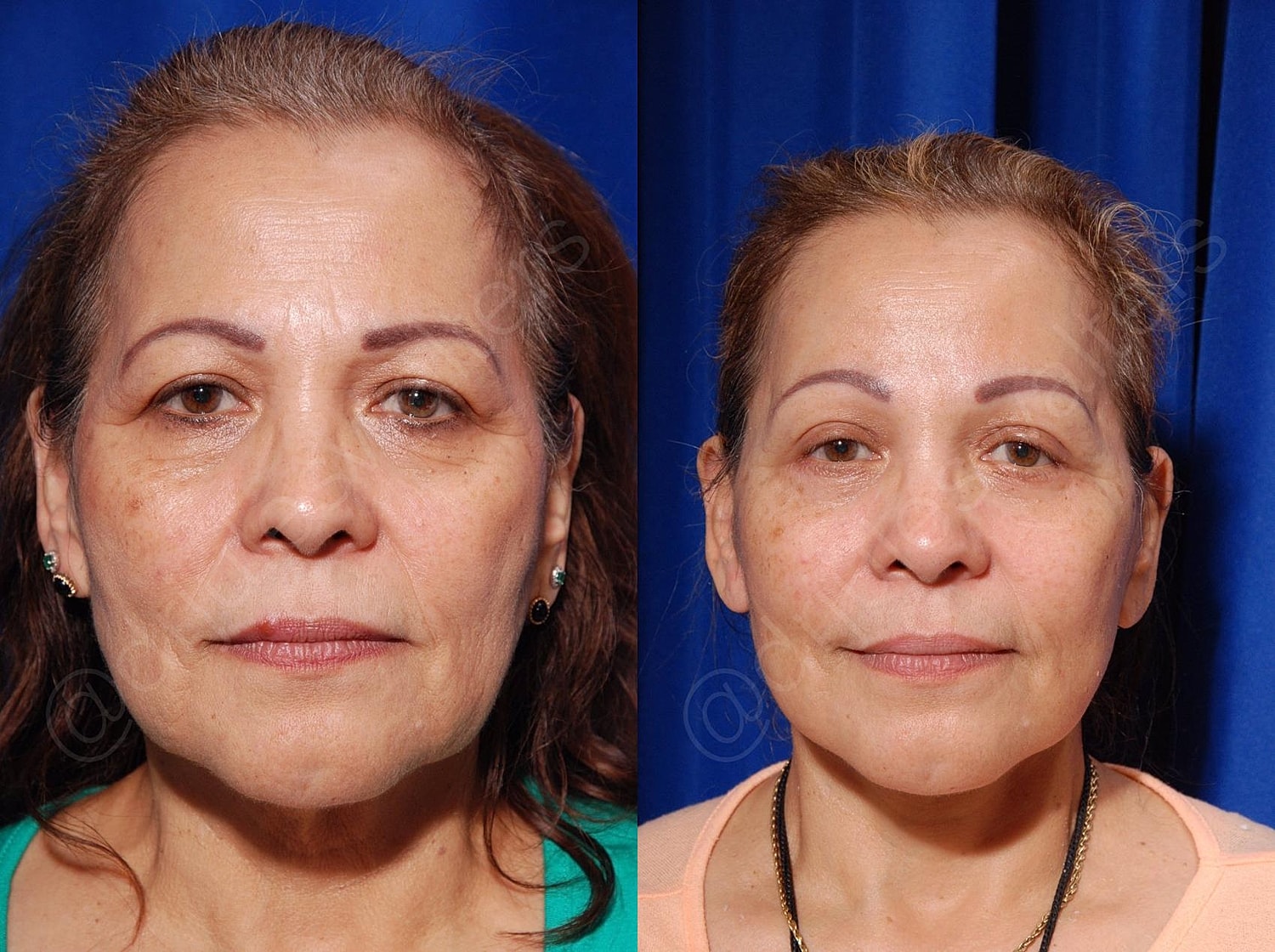 Blepharoplasty Before & After