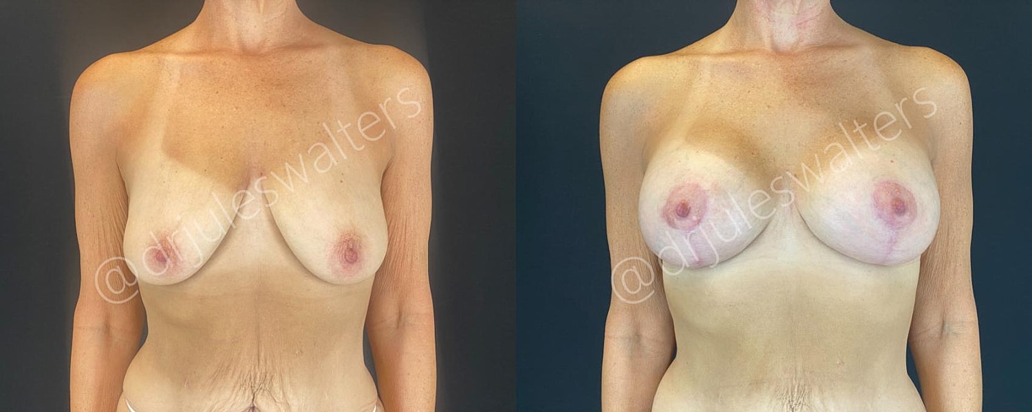 Breast Augmentation Lift Before & After