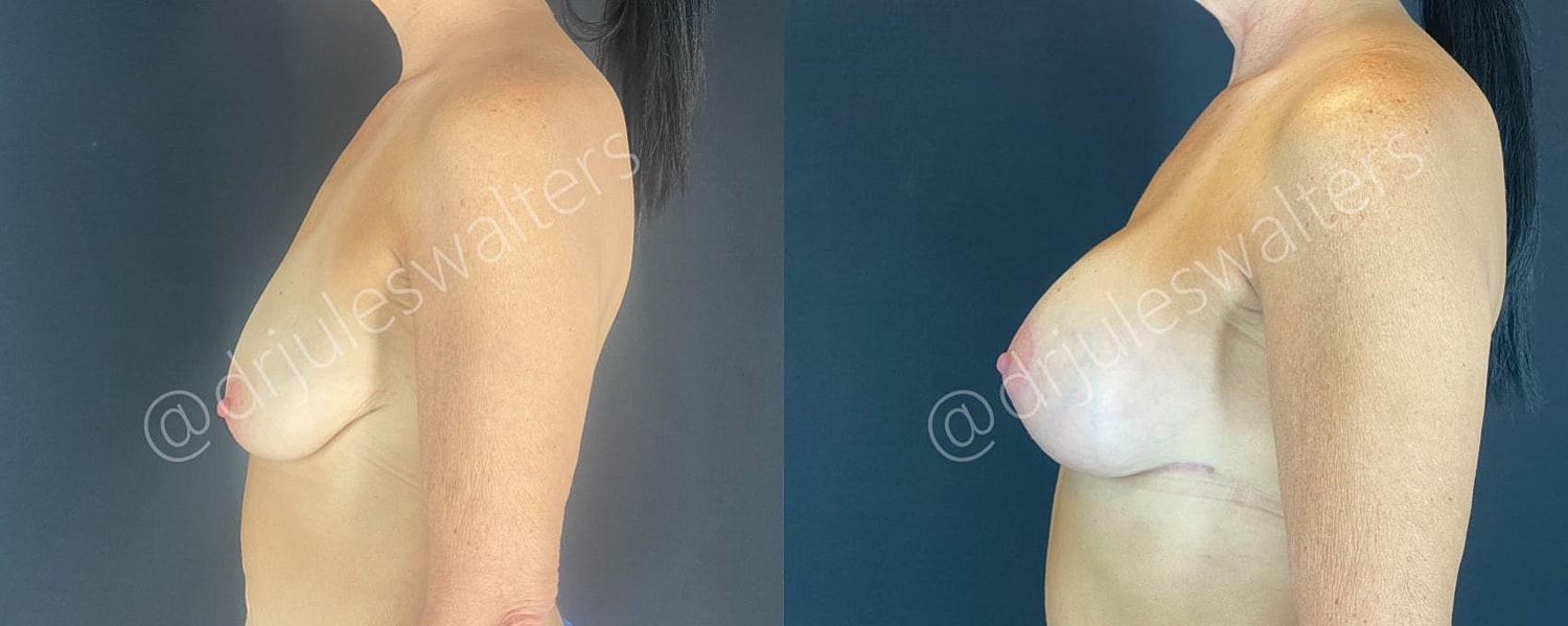 Breast Augmentation Lift Before & After