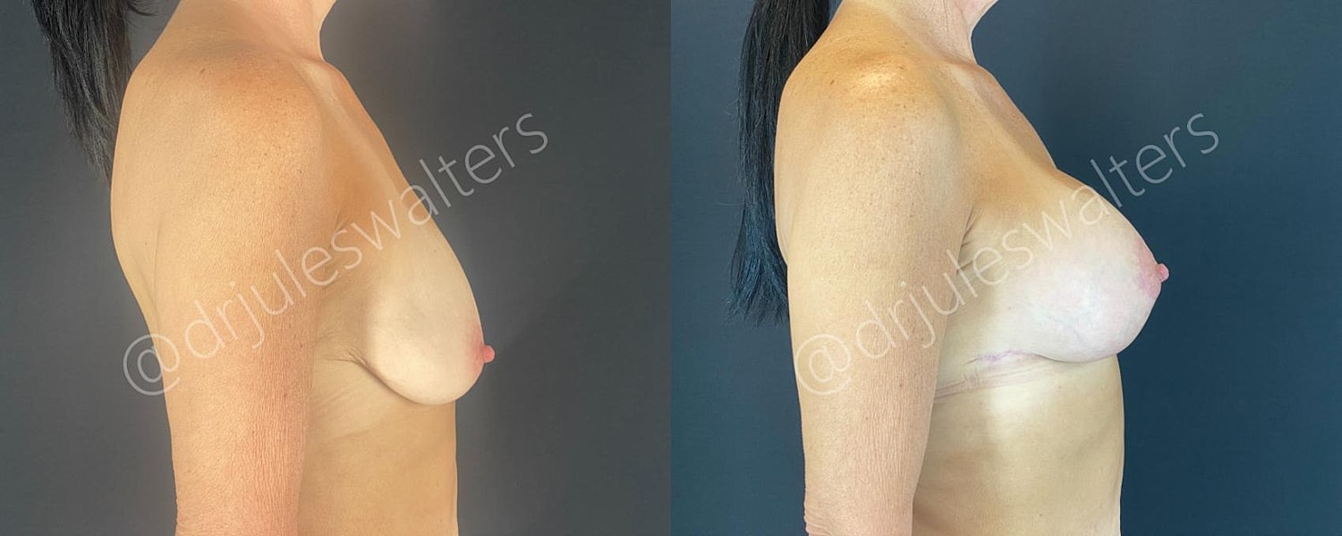Breast Augmentation Lift Before & After