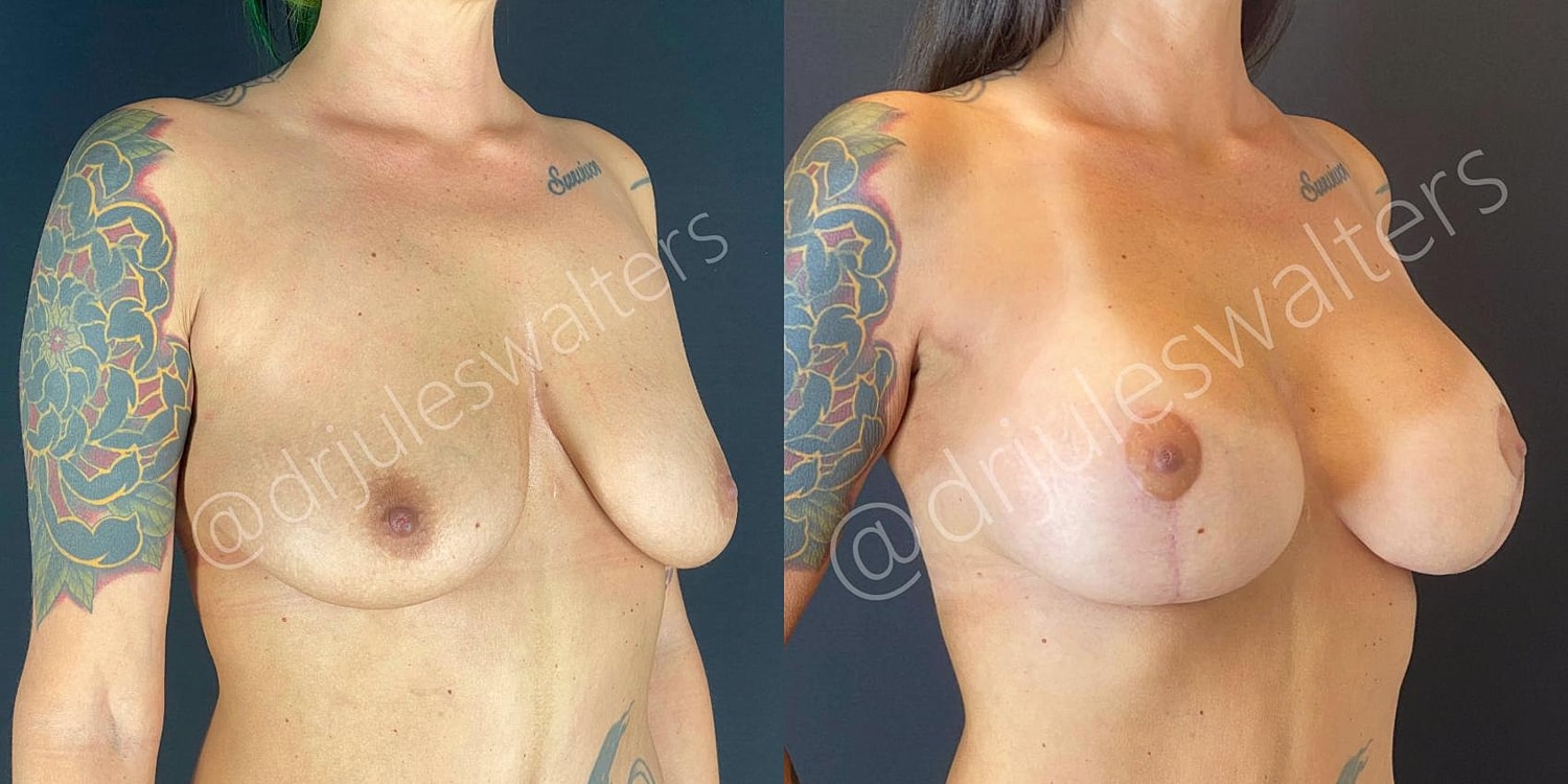Breast Augmentation Lift Before & After