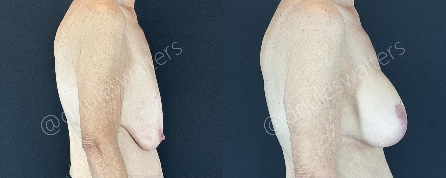 Breast Augmentation Lift Before & After