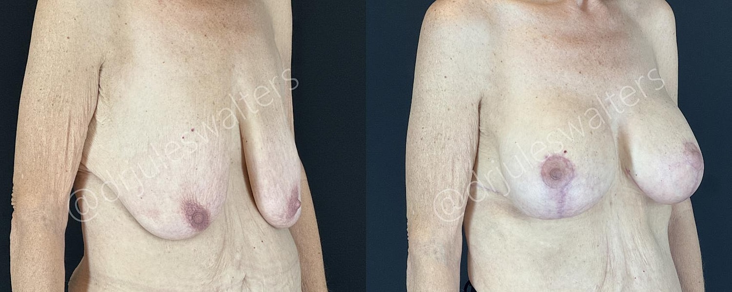 Breast Augmentation Lift Before & After
