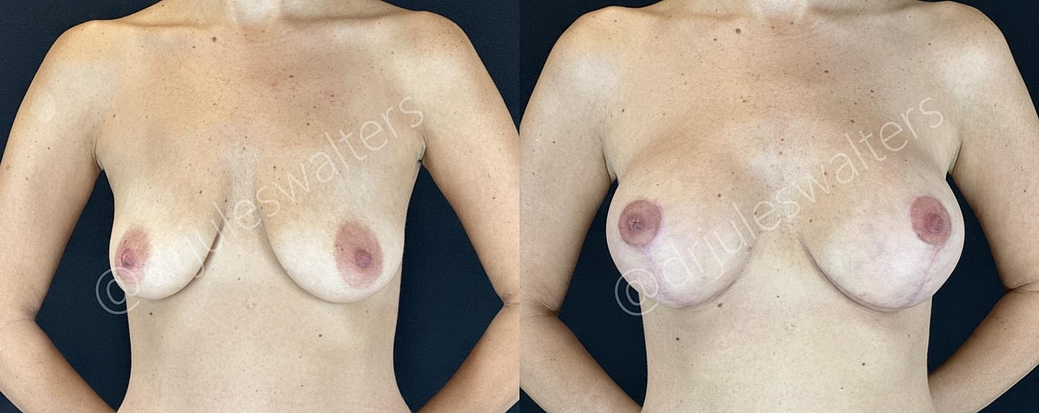 Breast Augmentation Lift Before & After