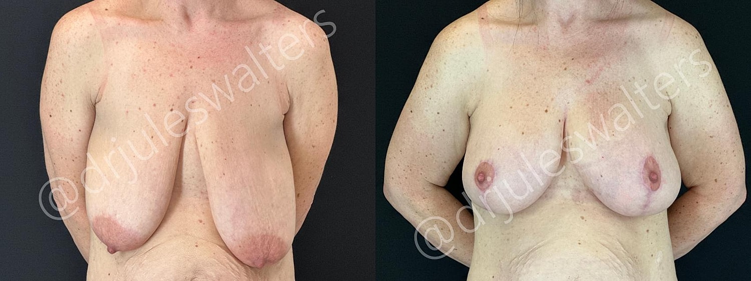 Breast Augmentation Lift Before & After