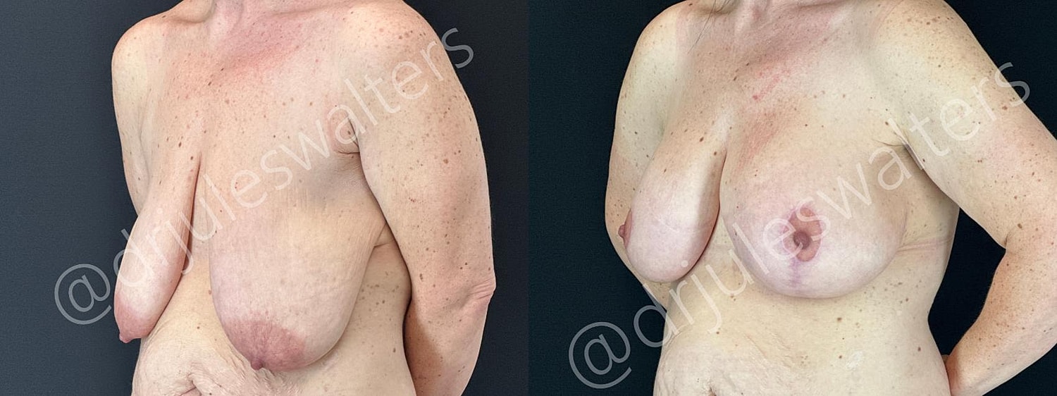 Breast Augmentation Lift Before & After