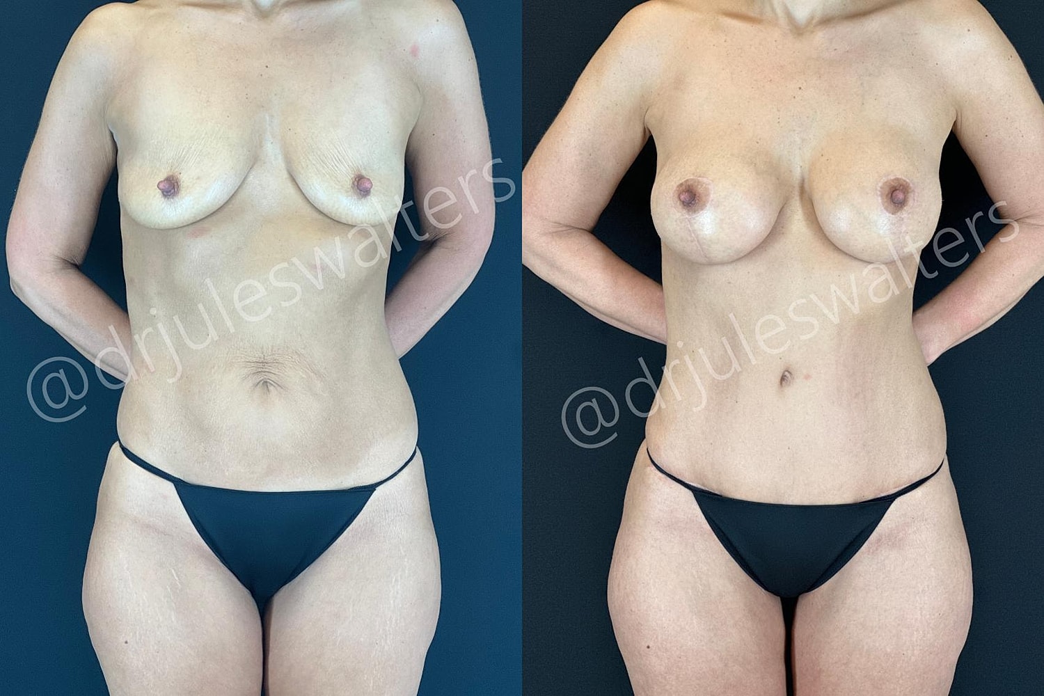 Breast Augmentation Lift Before & After