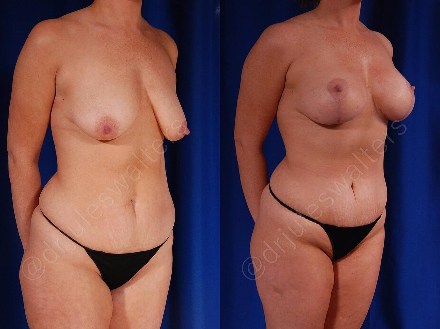 Breast Augmentation Lift Before & After