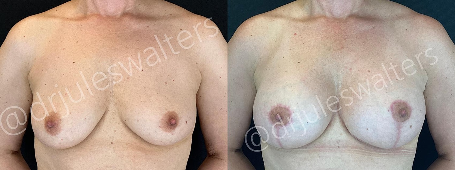 Breast Augmentation Lift Before & After