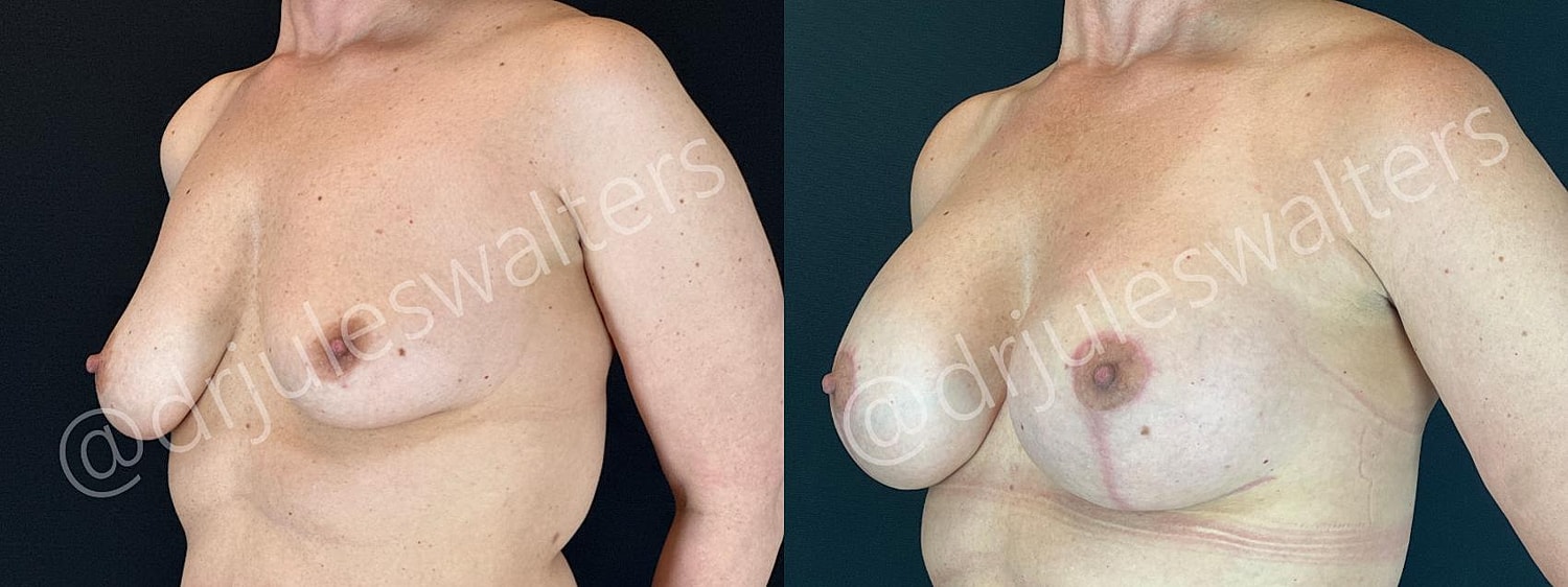 Breast Augmentation Lift Before & After