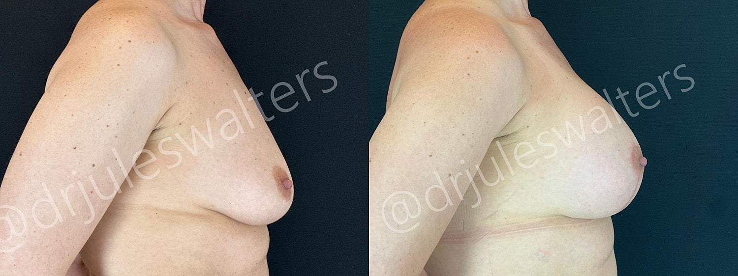 Breast Augmentation Lift Before & After