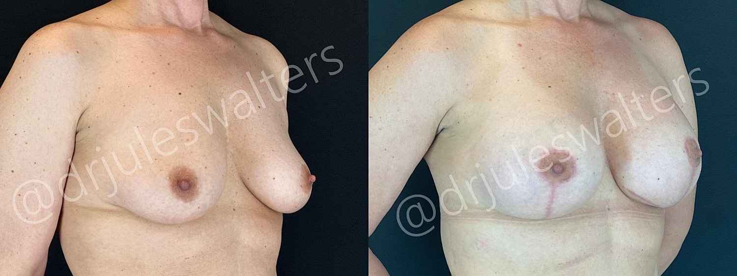 Breast Augmentation Lift Before & After