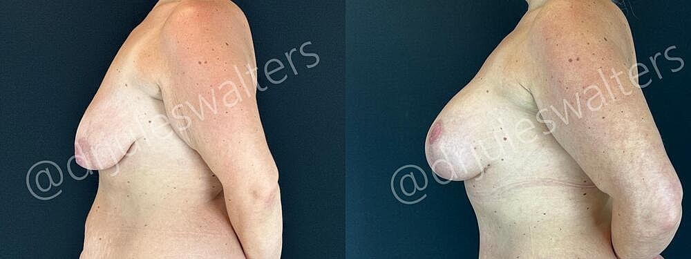 Breast Augmentation Lift Before & After