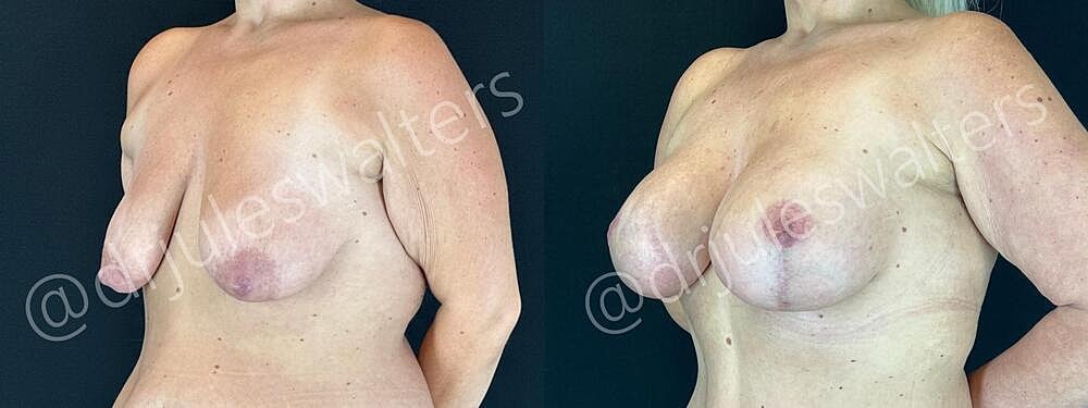 Breast Augmentation Lift Before & After