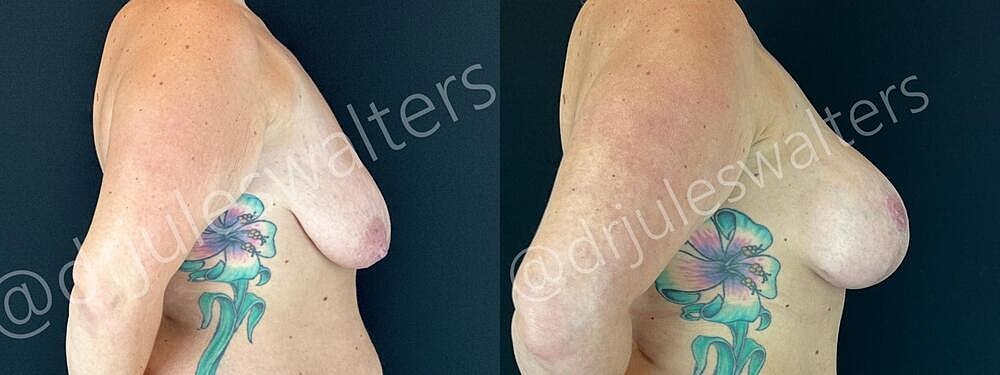 Breast Augmentation Lift Before & After